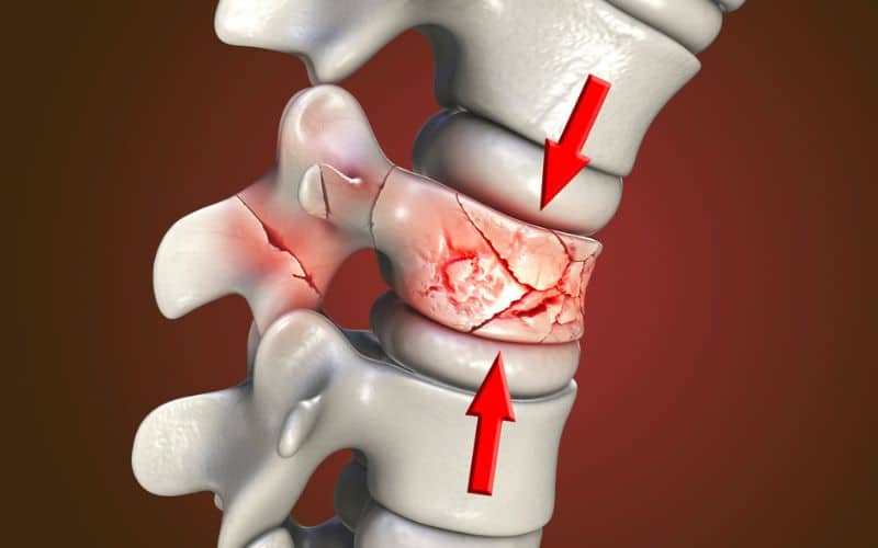 spinal fracture traumatic vertebral injury